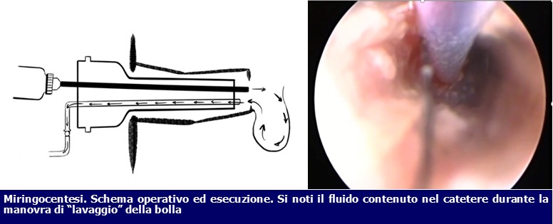 otite-media-cane-procedura-miringocentesi-ecm-veterinari